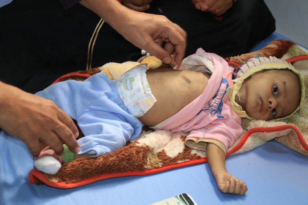 葉門一所醫院罹患嚴重急性營養不良的男孩。Photo: UNICEF/Abdoo Al-Karim